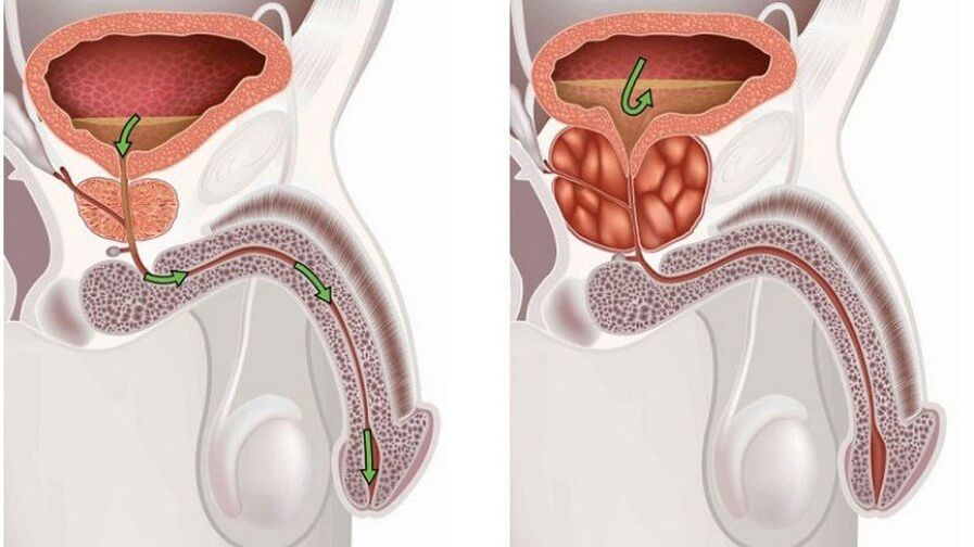 Prostatitis a Männer